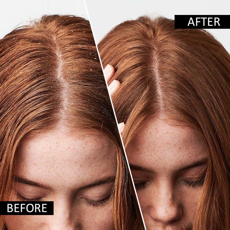 Anti-Dandruff & Anti-Itch Charcoal Detox Hair Mask - Image 10